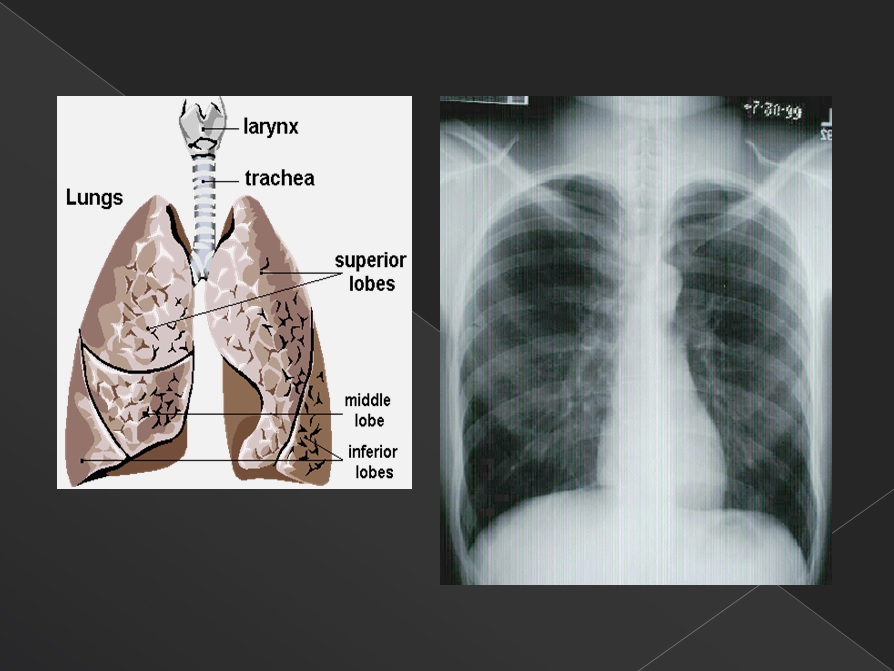 폐의 해부학적 구조와 폐암 3