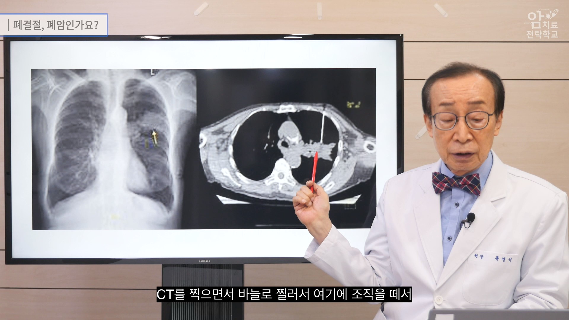 폐결절, 폐암인가요? | 휘경 우리들내과의원